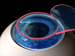 Astigmatism