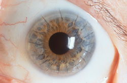 CornealGraft