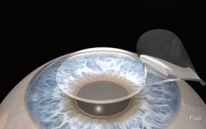 E01-03-LASIK-Conventional
