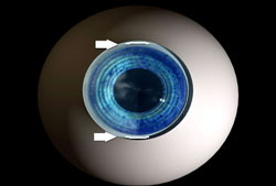 LimibalRelaxingIncisions