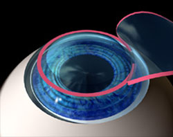 Nearsightedness