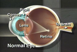 CornealUlcers