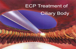 ECPTreatment