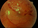 RetinalVeinOcclusion